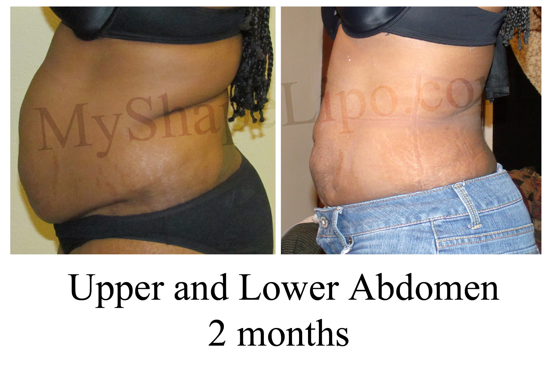 liposuction-vs-tummy-tuck-top-5-reasons-liposuction-is-the-best-choice